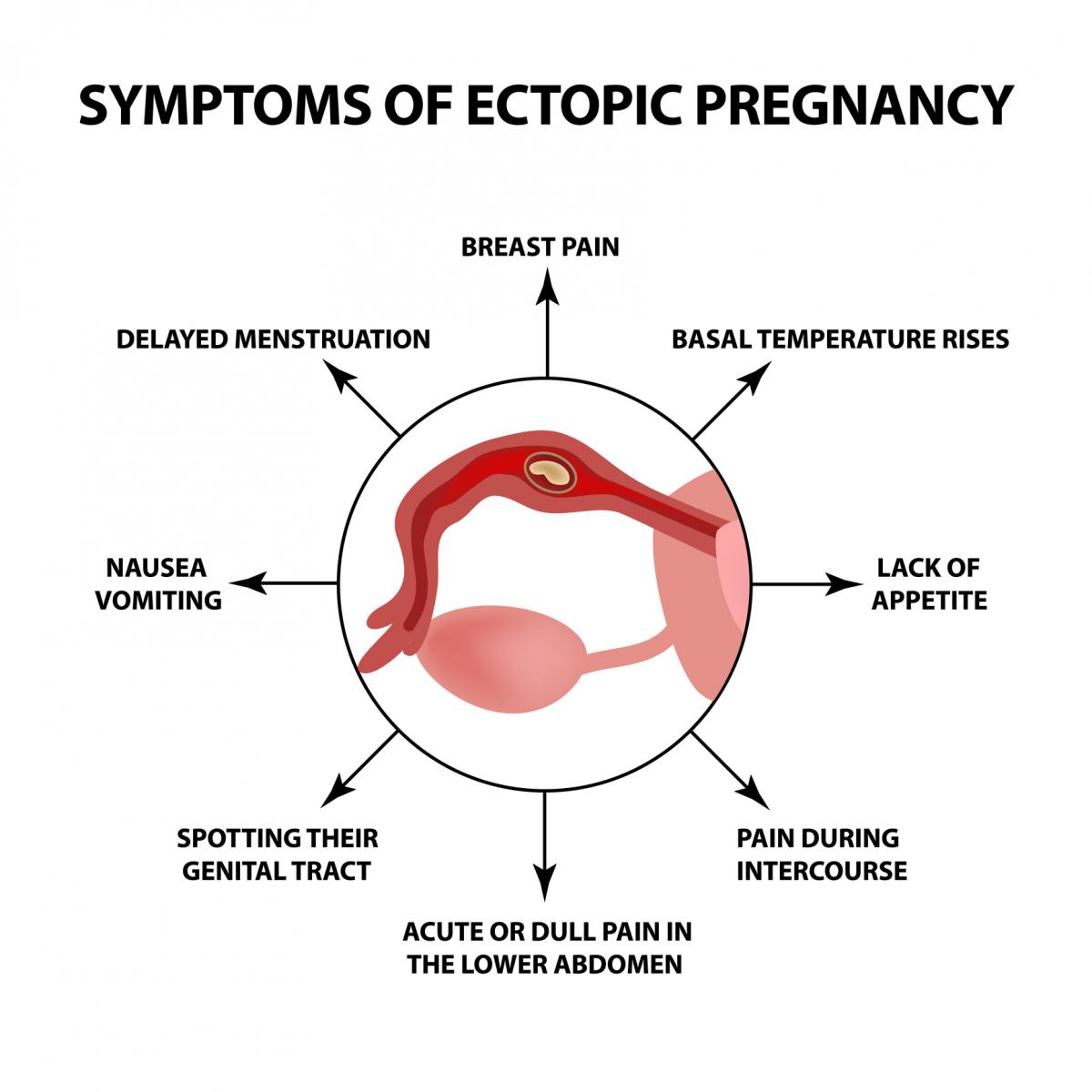 ectopic-pregnancy-calgary-guide